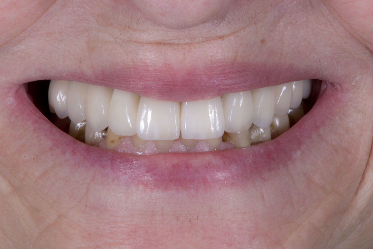 Risultato finale: riabilitazione estetica in ceramica integrale dall'aspetto naturale