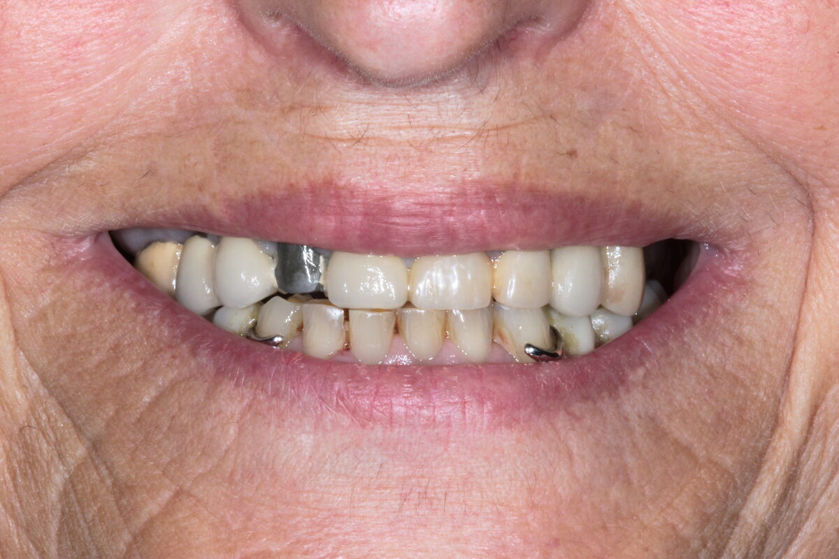 Situazione iniziale: vecchie corone in metallo-ceramica con margini scuri visibili