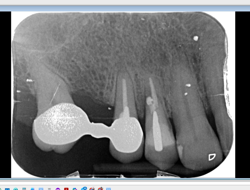 Radiografia endorale di controllo