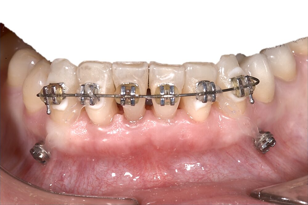Bracket con mini-vite di ancoraggio su arcata inferiore