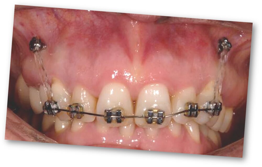 Apparecchio ortodontico con bracket su arcata durante il trattamento