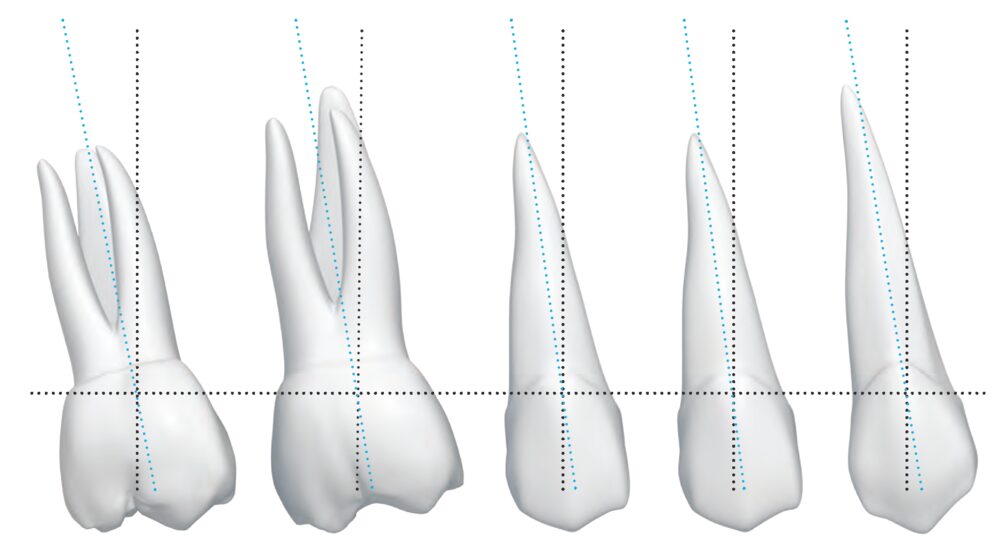 Schema dell'inclinazione ideale dei denti secondo le chiavi dell'occlusione