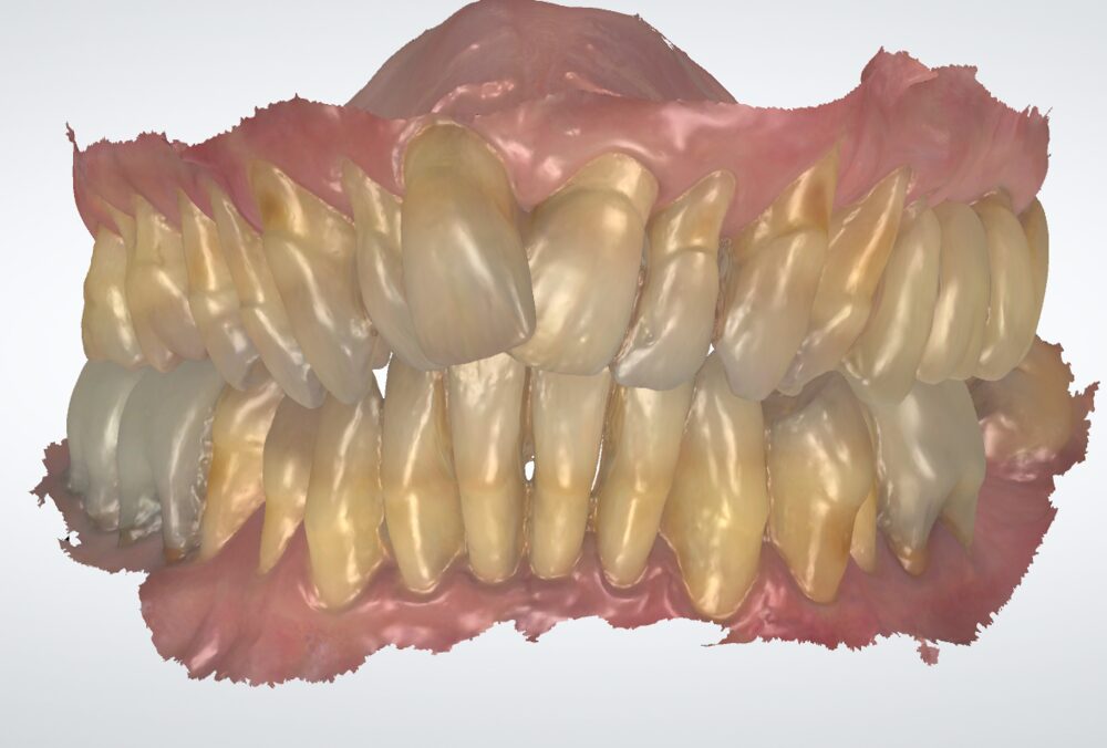 Scansione 3D di arcata con usura dentale severa