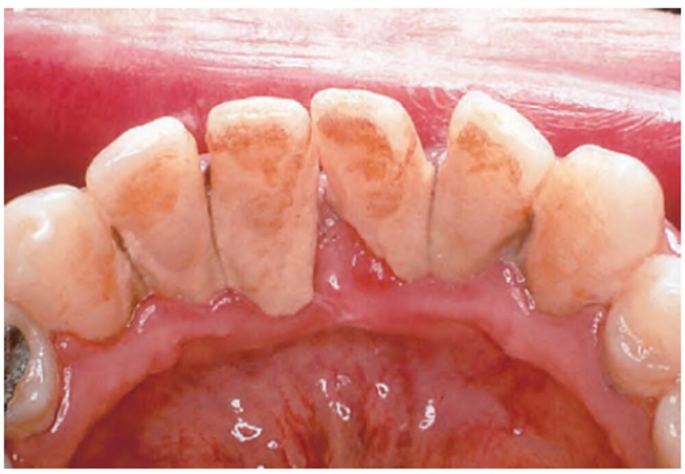 Accumulo di placca e tartaro sui denti inferiori con infiammazione gengivale