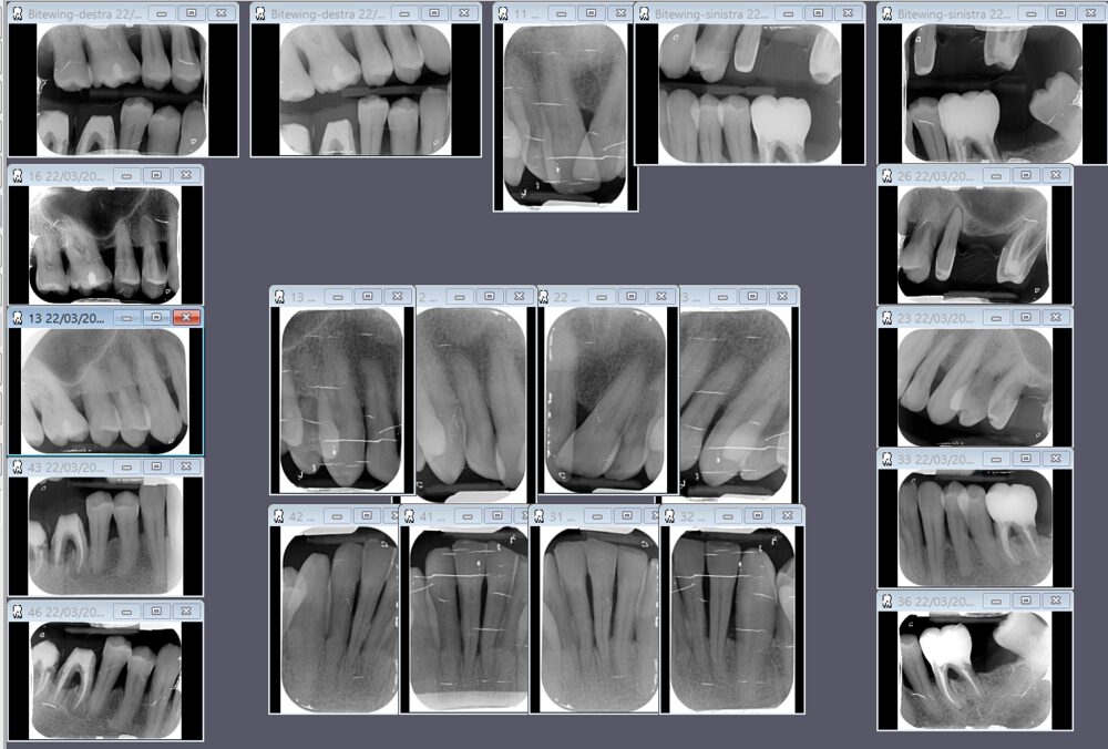Status radiografico completo della bocca